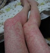 �����ݷ���Ƥ����ҽԺ��